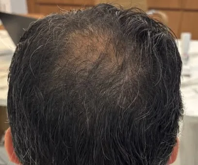 Vista superior da cabeça de um paciente, comparando a coroa antes e depois do tratamento sem cirurgia