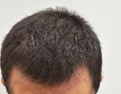 Vista frontal superior da cabeça de um paciente, comparando a linha capilar antes e depois do transplante