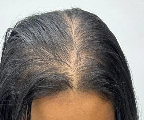 Vista superior da cabeça de uma paciente, comparando a densidade ao longo da risca antes e depois do tratamento sem cirurgia
